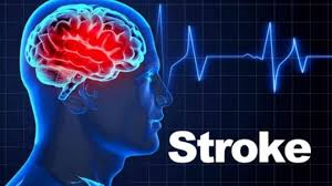 Stroke prevention, warning signs